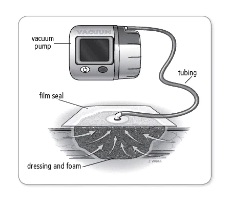 Terapi Luka Tekanan Negatif NPWT Portabel dengan Kit Pembalut NPWT VAC