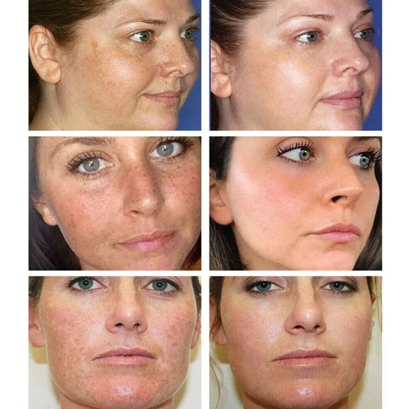 Crema per la rimozione delle lentiggini rimuovi le macchie del viso pelle macchie scure rimuovi macchie di età Melasma macchie solari crema sbiancante e rimozione delle lentiggini