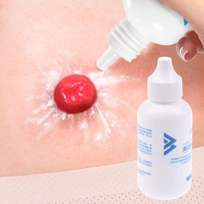25g Skin Care Flour Dry Flour Stoma Treatment Medical For Tool Ostomy Accessory Colostomy Bag Supply Protective Care Products