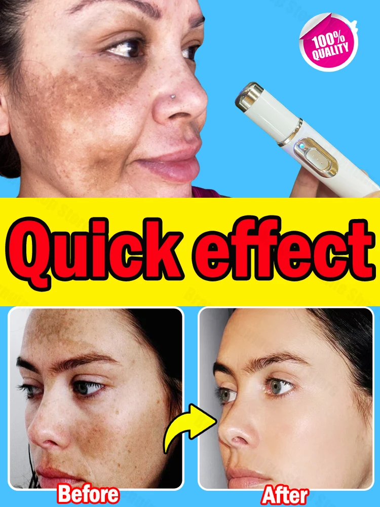 

laser whitening spots facial