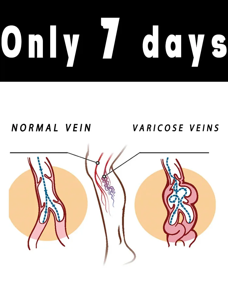 

Say goodbye to varicose veins and spider legs in 7 days
