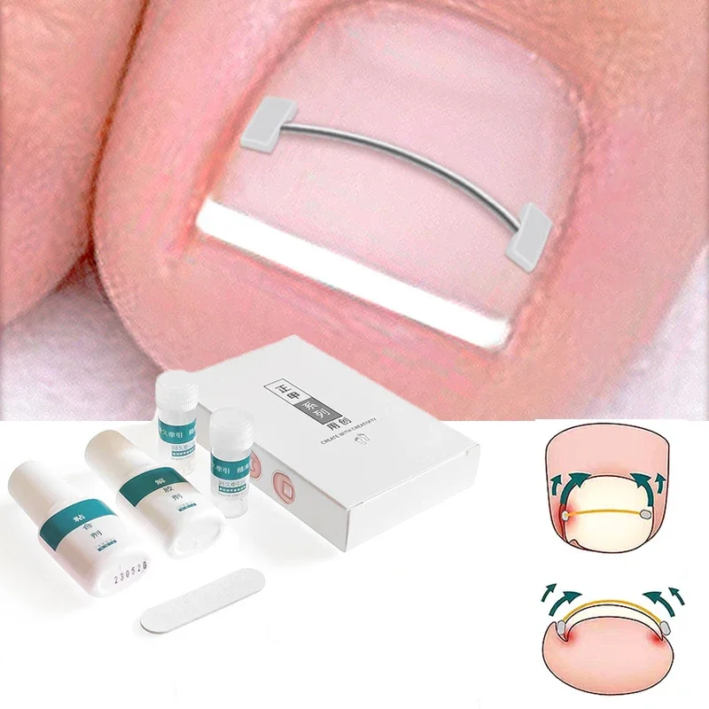 Ingrown Toenail Correction Tools Professional Treatment Recover Embed Toe Nail Device Pedicure Podiology Straightening Toe Tools