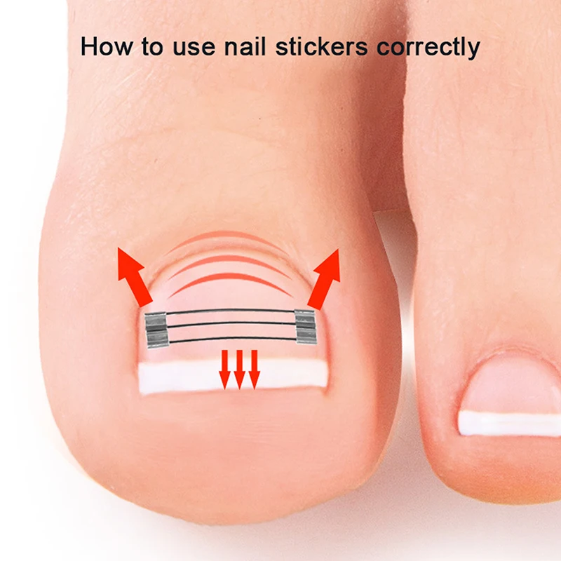 Corrector de uñas encarnadas, herramientas de sujeción, recuperación de pedicura, tratamiento de uñas encarnadas profesional, alisado de uñas encarnadas