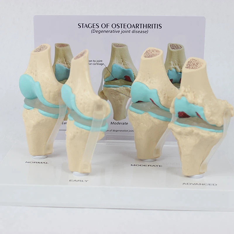 골관절염 해부학 모델 무릎 키트, 교육 키 카드 포함, 4 단계 무릎 모델, 정형 외과 교육 보조
