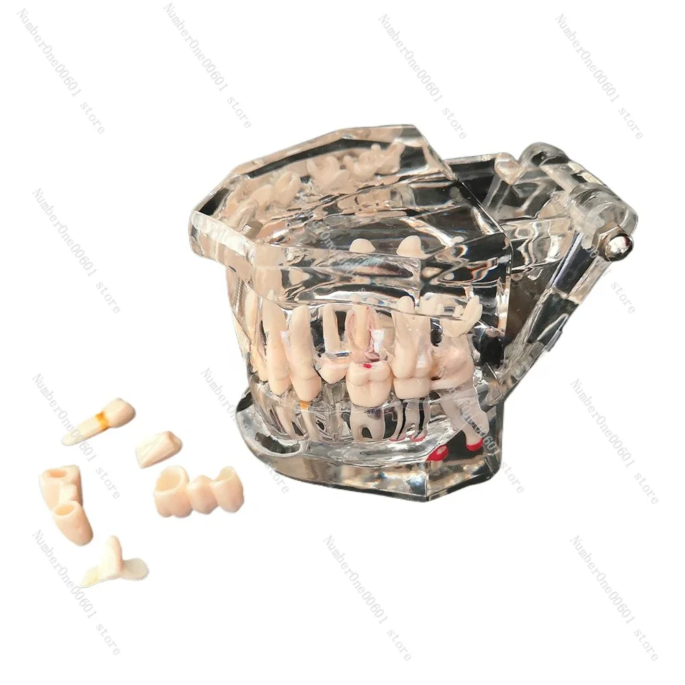 

Dental Pathology Bridge Dental Implant Model Removable Tooth Model