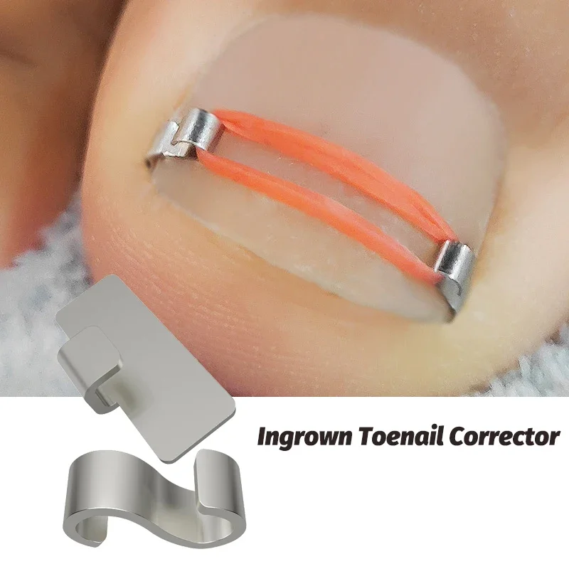 Ingrown Toenail Cor…