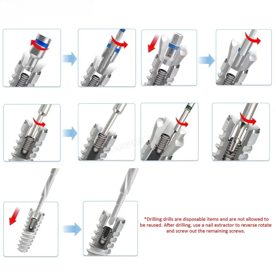 응급 치과 수술 도구 중앙 임플란트의 실패 및 수리를 위한 깨진 나사 추출기 기본 나사 제거 도구
