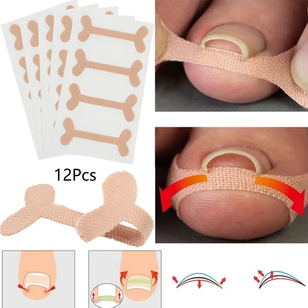 Pedicure patch Nail Toe Teratment unghie incarnite per decalcomanie dei piedi Paronychia Pedicure strumenti Pedicure Sticker strumento per la cura dei piedi