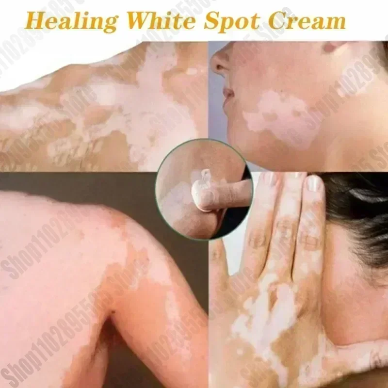 Sdotter New Best Sellers White Spot  for Vitiligo White Spots Leukoplakia Pigmentation Melanin Promoting Vitiligo  Skin Care0903