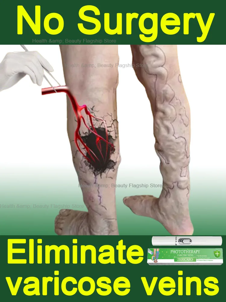

Get rid of varicose veins reduce pain restore normal blood circulation