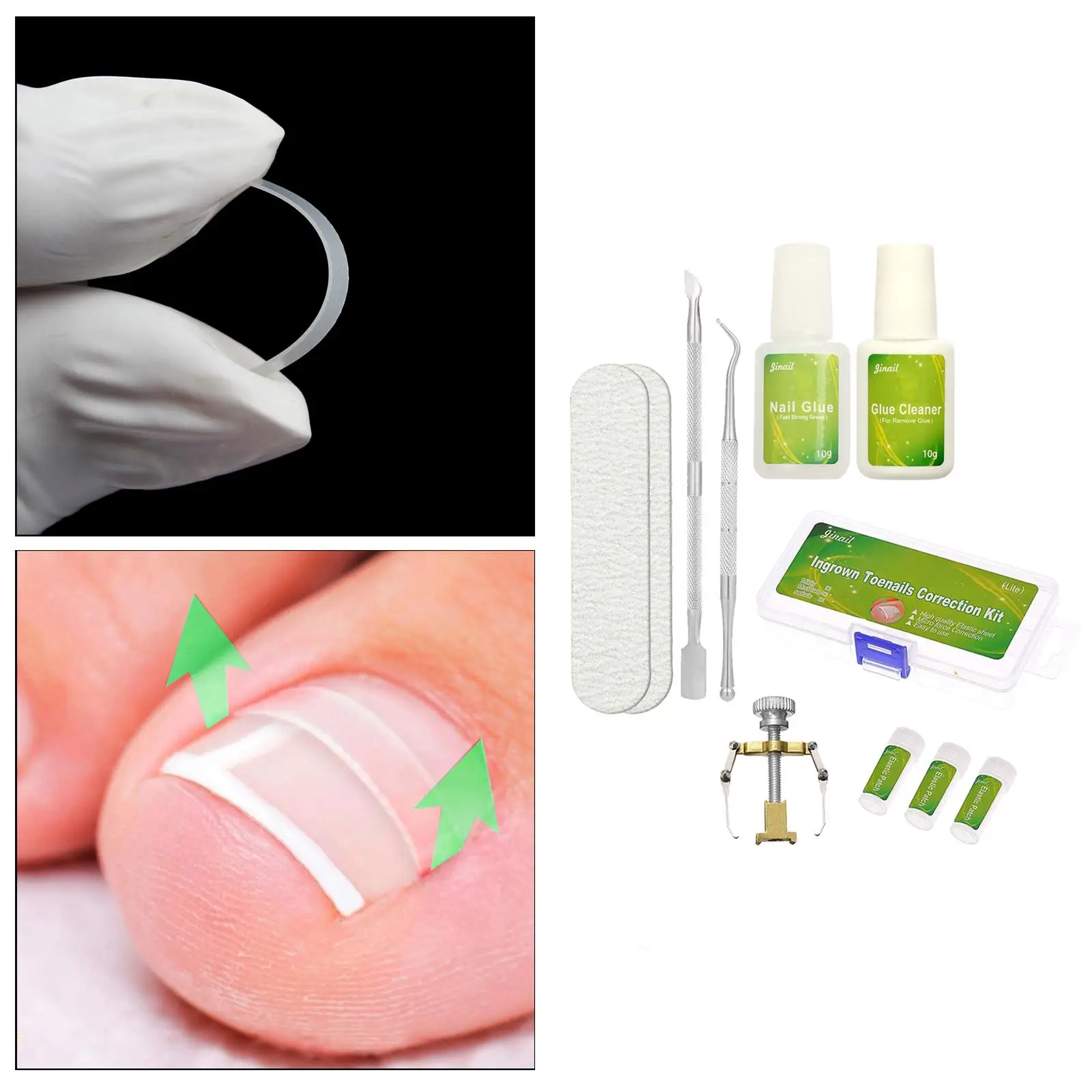 

Nail Correction Sticker Ingrown Toenail Correction Treatment Sticker Pedicure