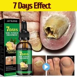 Fungal Nail Treatment Essence Oil Nail Fungus Laser Device Repair Toenail Fingernail Ginger Treatment Hand Foot Essence Liquid