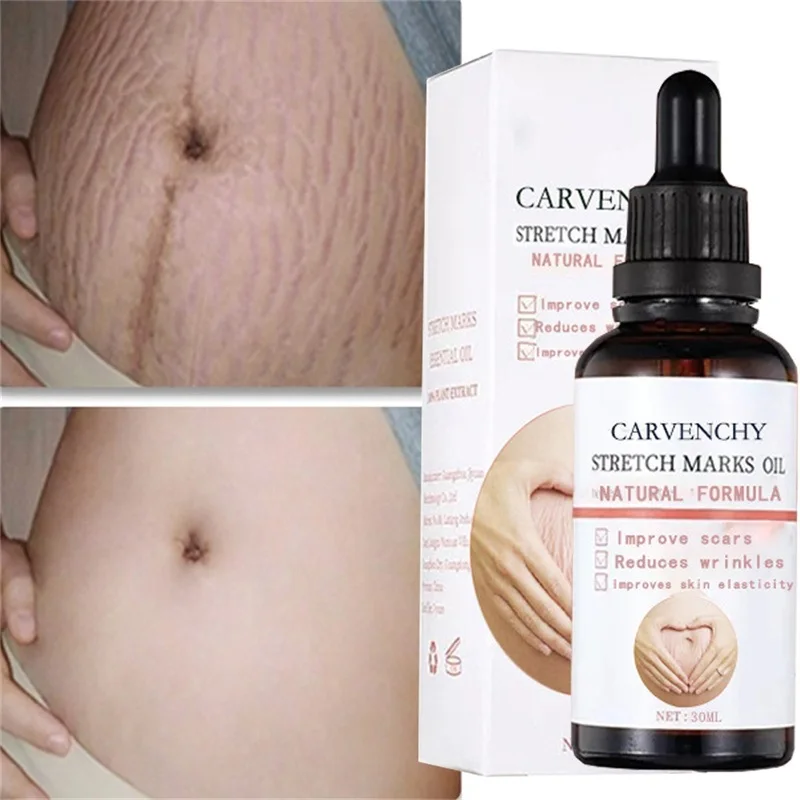 Stretch Marks Remover Essential Oil Pregnancy Maternity Body New Old Stretch Mark Removal Serum Increase Elasticity of Skin