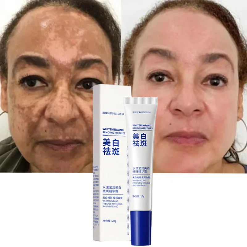 

Effective Whitening Freckles Cream Remove Melasma Dark Spots Fade Pigmentation Moisturize Brighten Face Skin Care Product