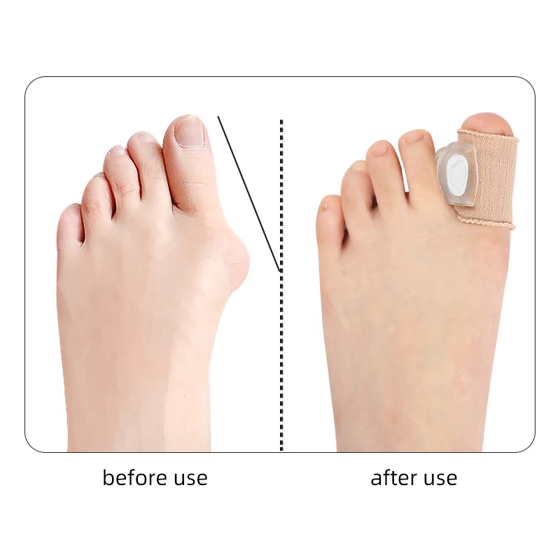 Toe Separator Silicone Pedicure Tools Bones Orthopedics Bunion Corrector Gel Insoles Shoes (2pc Splitter+5pc Adjusting spacer)