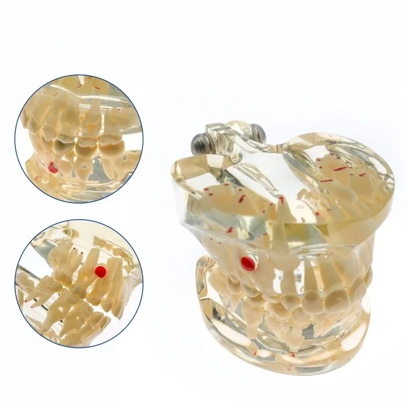 Study Tooth Transparent Adult /Children Pathological Teeth Model Lab Equipment Teaching