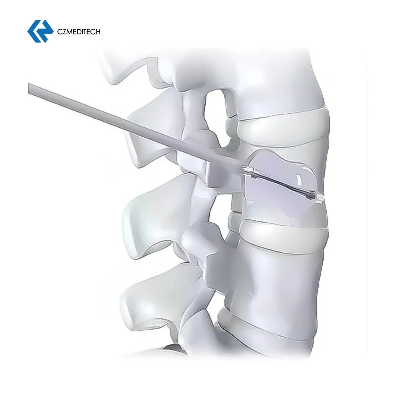 New Design  Spinal Surgery PKP Set Kyphoplasty Ballon And Tool System Thoracic Layer by Layer Puncture