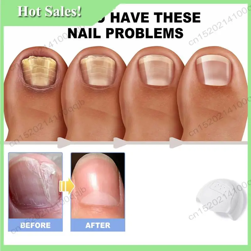 

-FDDT Lasers For Nail Fungu Treatment Device Cleaning Onychomycosis Fungal Nail Foot Repair Fungi Nails Removal