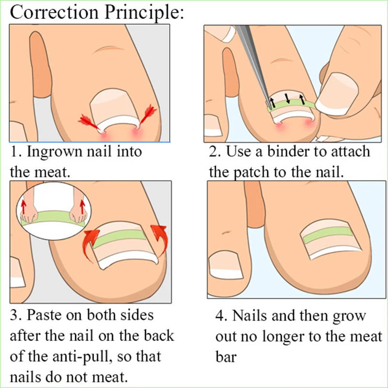 10Pcs Ingrown Toenail Correction Tool Ingrown Toe Nail Treatment Elastic Patch Sticker Straightening Clip Brace Pedicure Tool