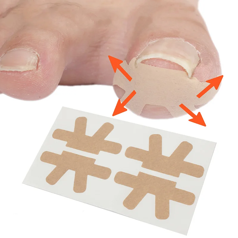 20-100Pcs Professional Ingrown Toenail Foot Corrector Stickers Elasticity Nail Care Pedicure Tools Health Care Protects Toe Nail