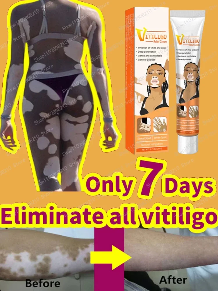 

Remove White Spot Eliminate Vitiligo skin Care Products