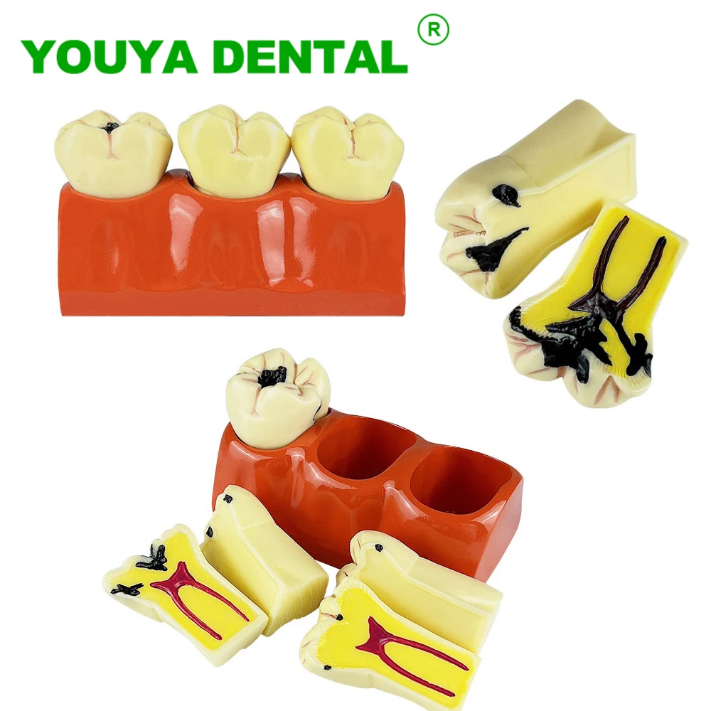 

Dental Teaching Model 4 Times Caries Comparison Model Patient-Communication Education Demonstration Tools Dentistry Products