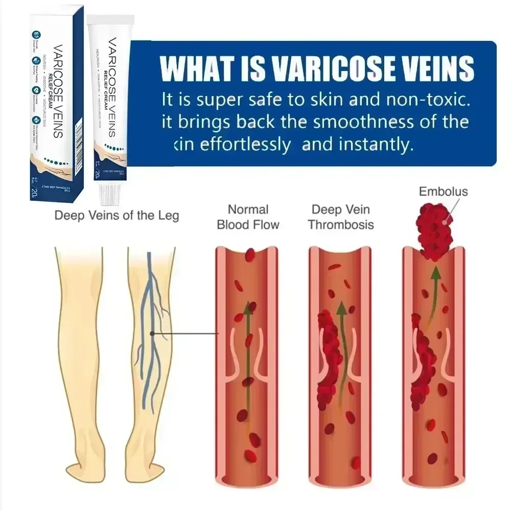 »»Crema per vene varicose Pelle naturale alle erbe Migliorata la circolazione sanguigna Sollievo dal gonfiore e trattamento delle vene del ragno