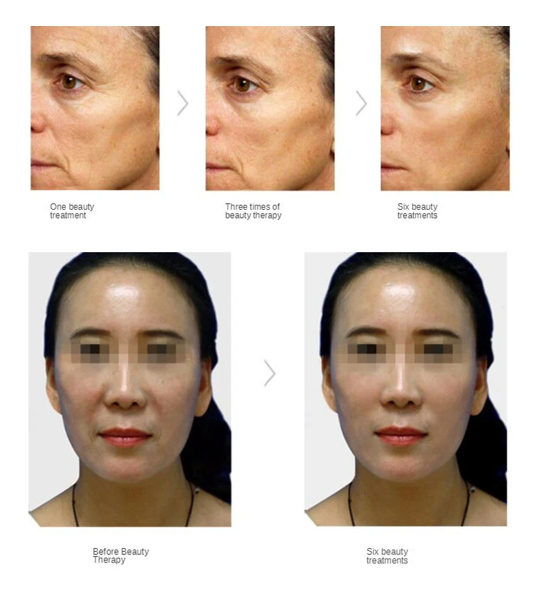 2 In 1 V-Mate Vmax No-cartridges Vmax Facial Lifting V Line Carving Skin Tightening Device Skin Tightening Machine