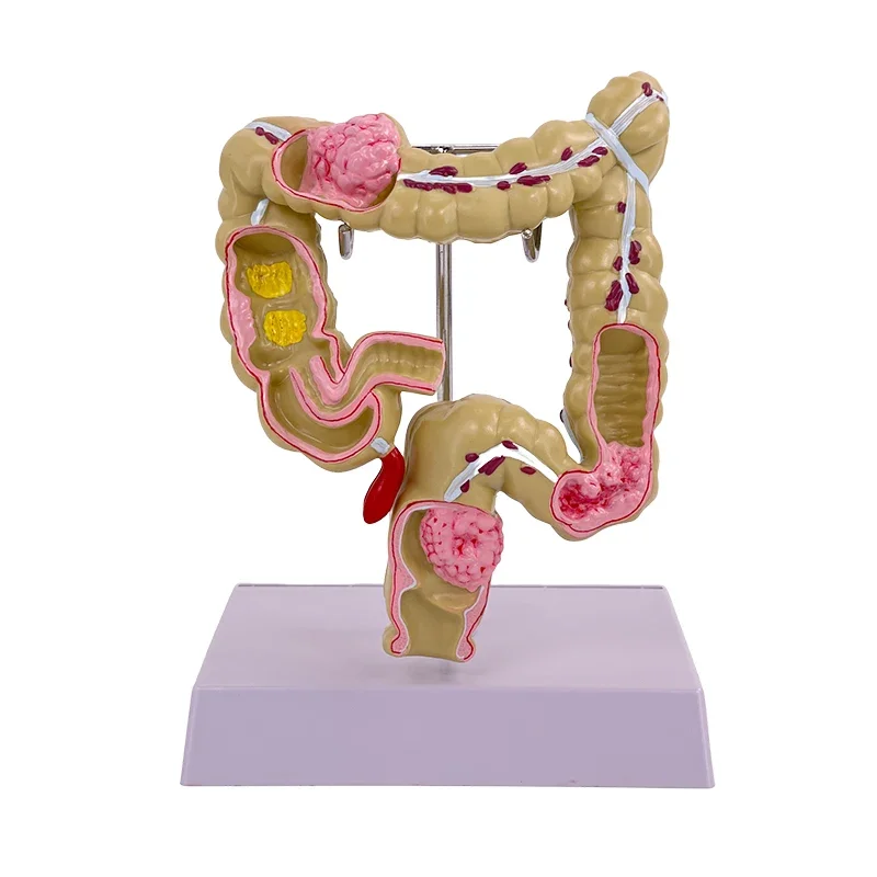 Colon pathological  Colon Gastrointestinal lesions Anatomical model Intestinal diseases Human colon lesions model