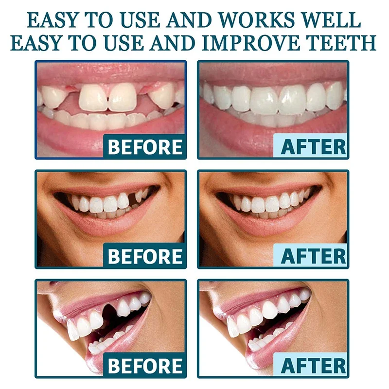 Conjunto De Dentes De Dentadura Ajustável, Folheado Instantâneo, Clareamento De Cintas De Dente, Resina Temporária, Dentes Sorridentes