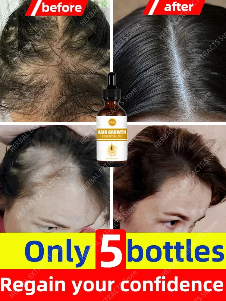 

O óleo de crescimento capilar faz o cabelo crescer rapidamente, repara eficazmente a calvície e a queda de cabelo hereditária