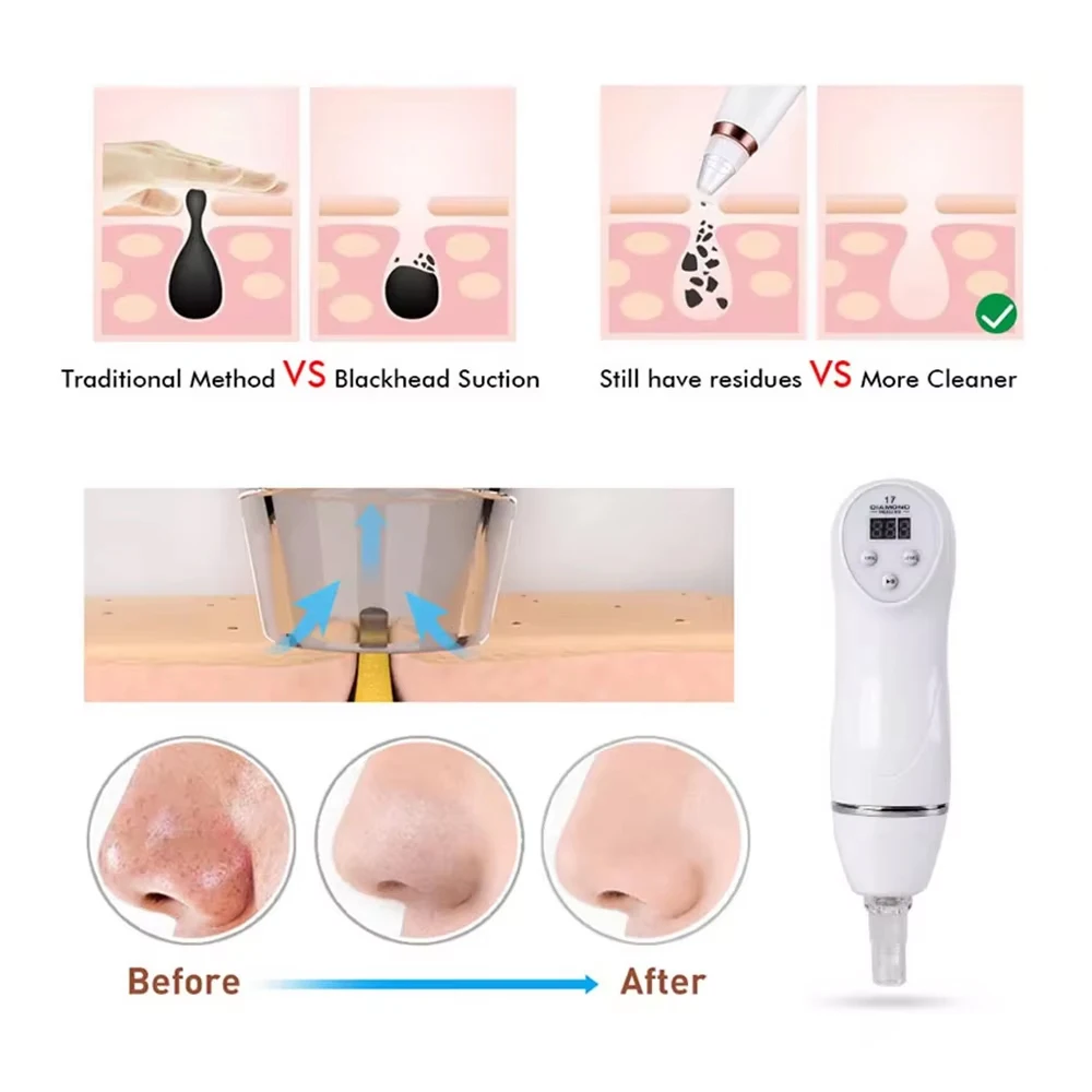 Elektryczny odkurzacz do usuwania zaskórników z nosa, cyfrowa mikrodermabrazja diamentowa, głębokie czyszczenie porów, urządzenie do usuwania śladów trądziku na twarzy.