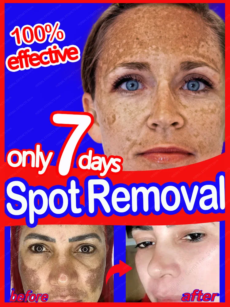 

Freckle Cream Anti Spots Blemish Melasma