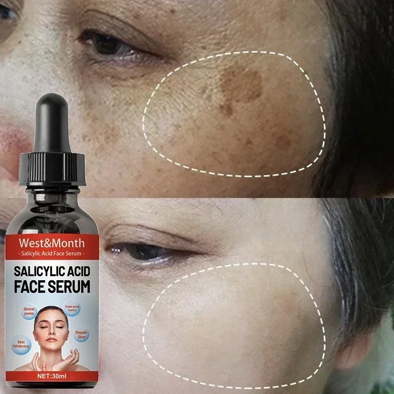 

Nicotinamide Attenuates Stains Facial Serum Salicylic Acid Shrinks Pores Freckle Removal Moisturizes Face Skin Care Serum 2025