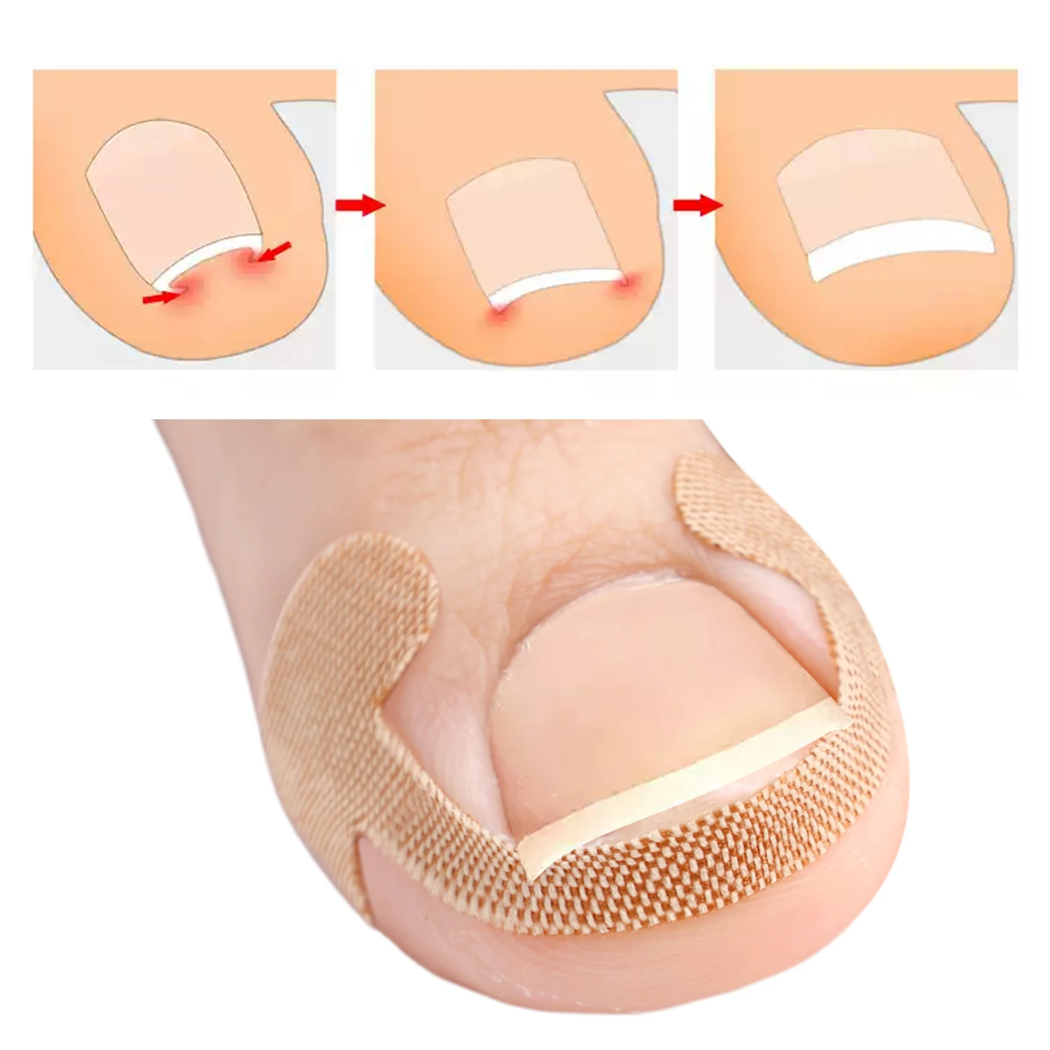 Bandes correctrices pour ongles incarnés, 100 pièces, adhérence durable, autocollants imperméables, élasticité, soins des orteils, outils de pédicure