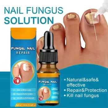 Fungal Nail Treatment Oil Foot Repair Essence เล็บเท้าเชื้อราเจลกําจัดครีมป้องกันการติดเชื้อ Fungal Nail Removal Paronychia