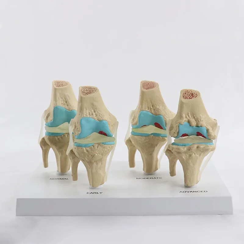 

Human Knee Joint Model, Stage 4 Disease, Knee Bone Structure Display, Anatomical Model, Medical Teaching, Tabletop Decoration