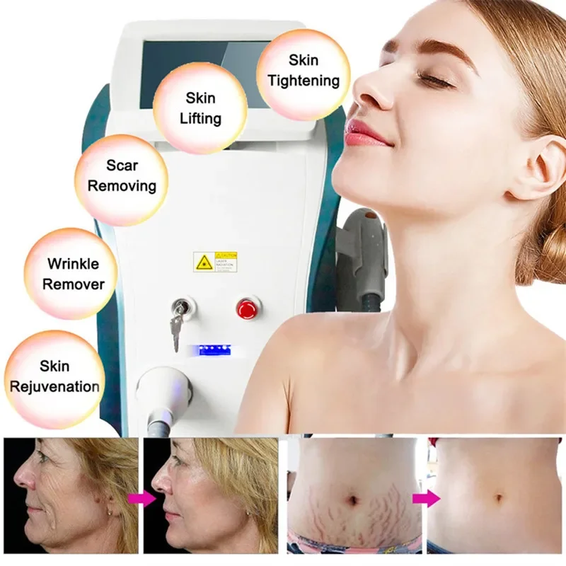 

M22 Freckle Remove OPT IPL Acne Treatment Vascular Removal Skin Rejuvenation Female Hair Removal Machine for Men