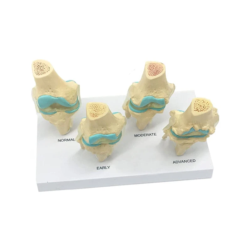 Four-stage Human Pathological Knee Joint Anatomy Model Medical Science Teaching Resources Dropshipping