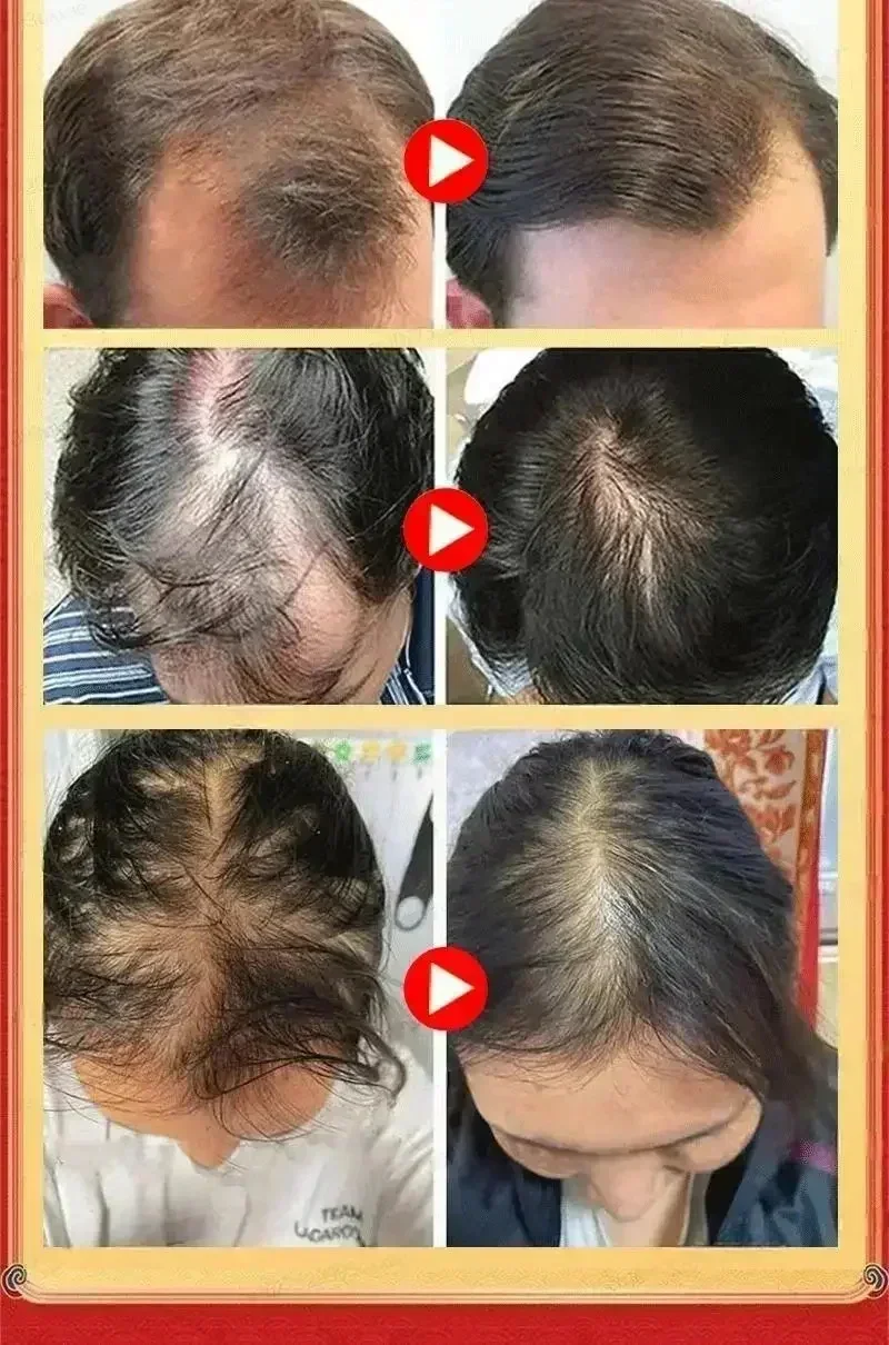Você precisa de um penteado!! O cabelo fica mais e mais, diga adeus à calvície, cabelo torna-se mais grosso, produtos mais vendidos.