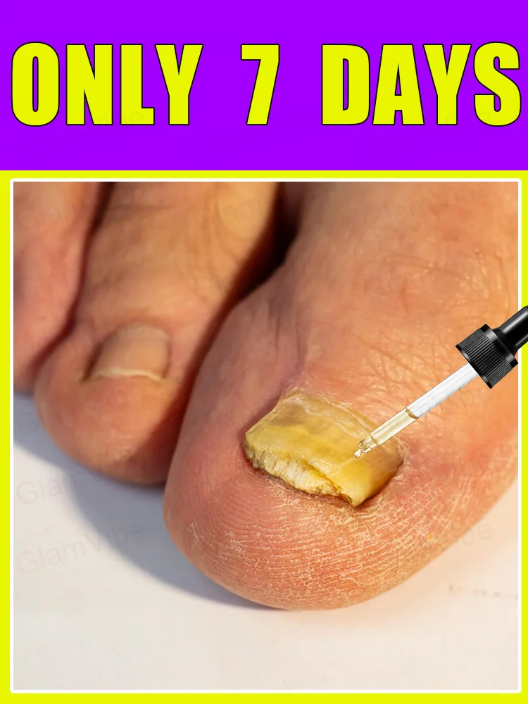 

Iɴsᴛᴀɴᴛ Eғғᴇᴄᴛ! Fᴜɴɢᴀʟ Nᴀɪʟ Essᴇɴᴛɪᴀʟ Oɪʟ, Tᴀʀɢᴇᴛɪɴɢ ᴛʜᴇ Rᴏᴏᴛ ᴏғ Fᴜɴɢᴜs,