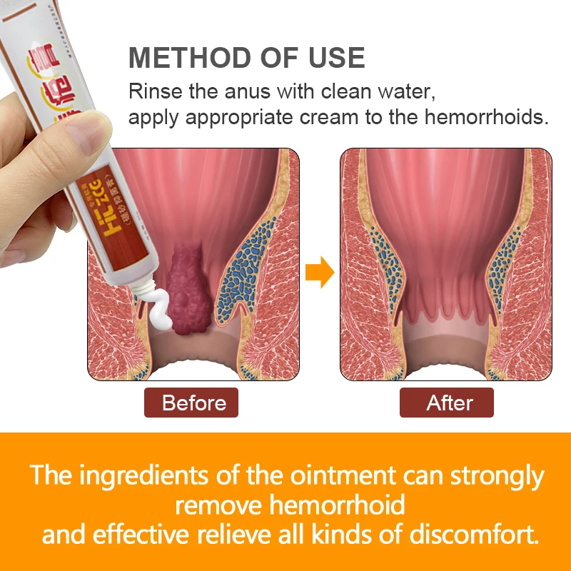 1pcs Hemorrhoid Pain Relief Cream Anal Swelling Bleeding Hemorrhoid Treatment Ointment Medical Hemorrhoid Removal Cream S001