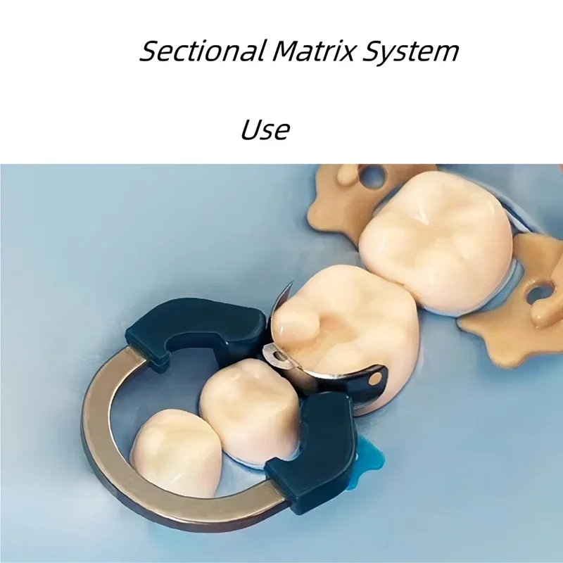 Bandas de matriz Dental NITI, anillo de abrazadera de matrices de Metal, sistema de matriz contorneada seccional, anillo de sujeción de titanio y