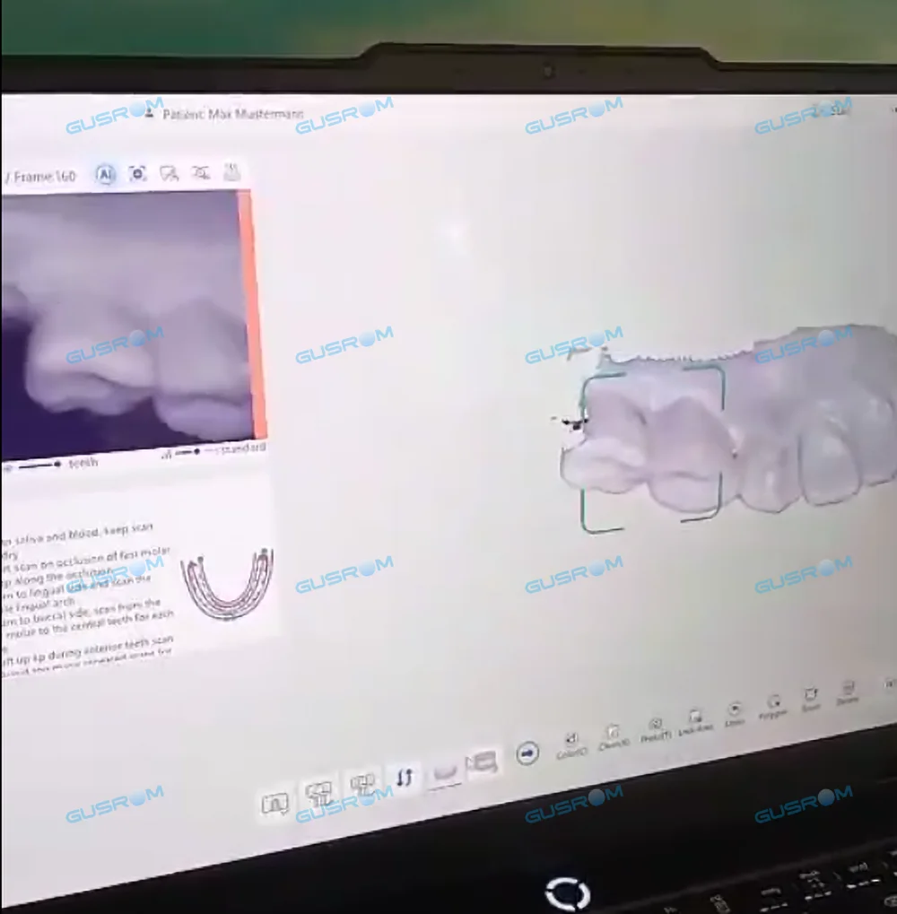 Gusrom GScan IQ ماسح ضوئي للأسنان داخل الفم عالي الدقة AI مسح سريع ثلاثي الأبعاد نظام مفتوح جهاز الانطباع الرقمي STL تصدير #5