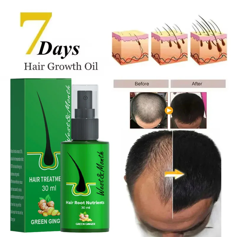 

Fast Ginger Hair Growth Spray Roots Grow Anti Hair Loss Hair Regrowth Serum Scalp Damaged Repair Nourish Care Products Women Men