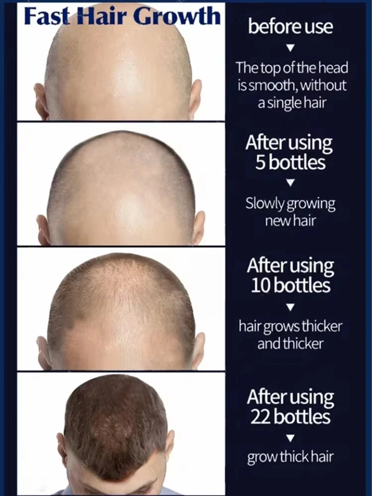 [THICK HAIR] say goodbye to baldness, have more and more hair, 99% of buyers buy again