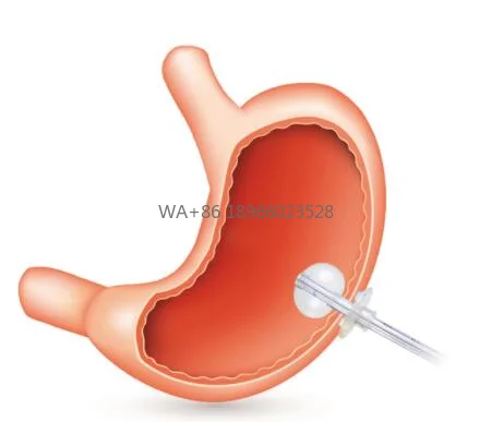 sonde-de-gastrostomie-en-silicone-pour-remplacement-medical