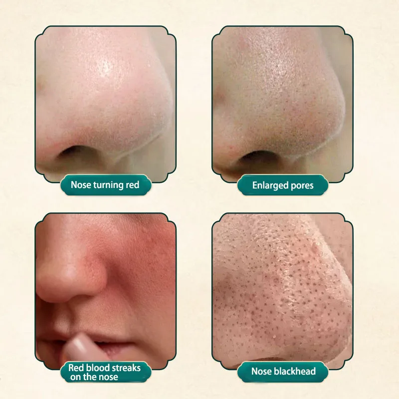 Rosacea Relief Repair Cream Sakajino Brand Soothes Redness on the Nose, Enlarged Pores, and Discomfort from Red Blood Streaks