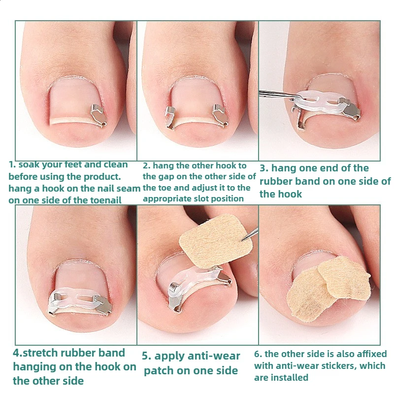 1/2 conjunto de ferramentas corretoras de unhas encravadas, pedicure, recuperação, tratamento de unhas, kit de reabastecimento de unhas, ferramenta de correção de cuidados com os pés