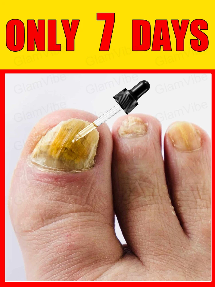 

Iɴsᴛᴀɴᴛ Eғғᴇᴄᴛ! Fᴜɴɢᴀʟ Nᴀɪʟ Essᴇɴᴛɪᴀʟ Oɪʟ, Tᴀʀɢᴇᴛɪɴɢ ᴛʜᴇ Rᴏᴏᴛ ᴏғ Fᴜɴɢᴜs,